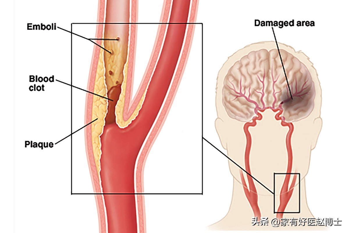颈动脉没有斑块可以停用他汀吗,一般他汀吃多久颈动脉斑块有效果