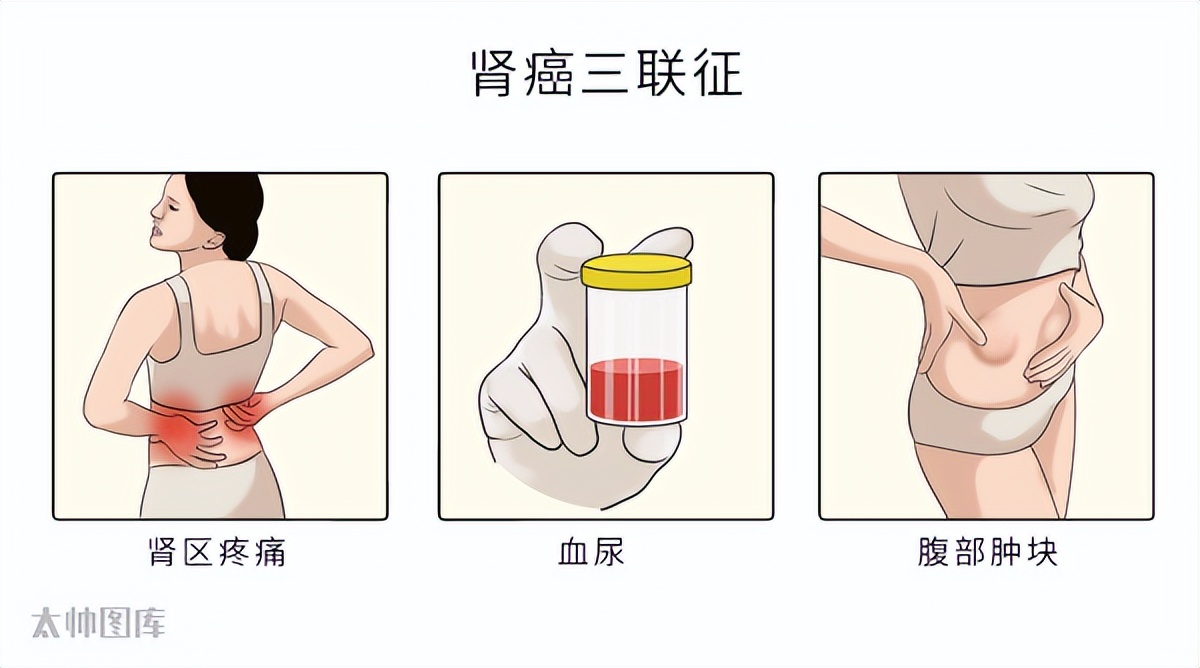 19种癌的早期信号和筛查建议——早知道能救命！