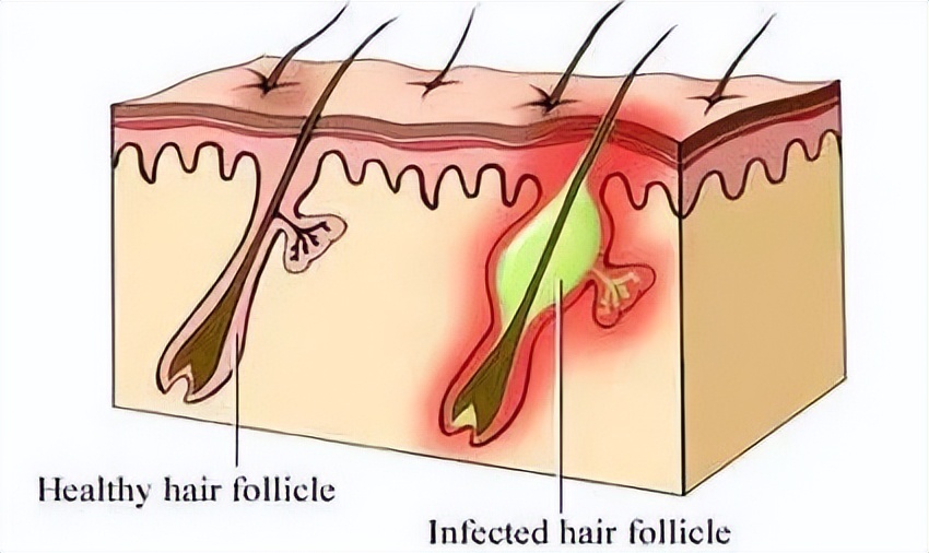 下身长痘痘怎么才知道是性病了,阴茎上起了一个痘痘是性病吗