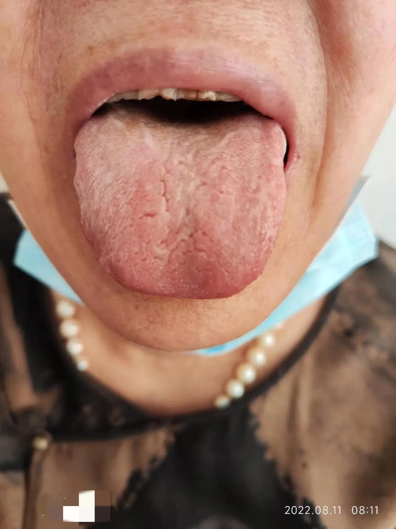 口服中药3个月，确诊5年的干燥综合征患者病情明显缓解