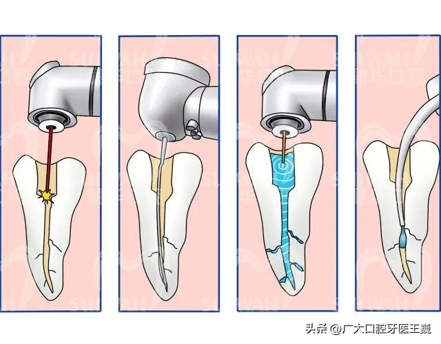 蛀牙快到牙神经要做根管吗,蛀牙痛到牙神经了最佳治疗