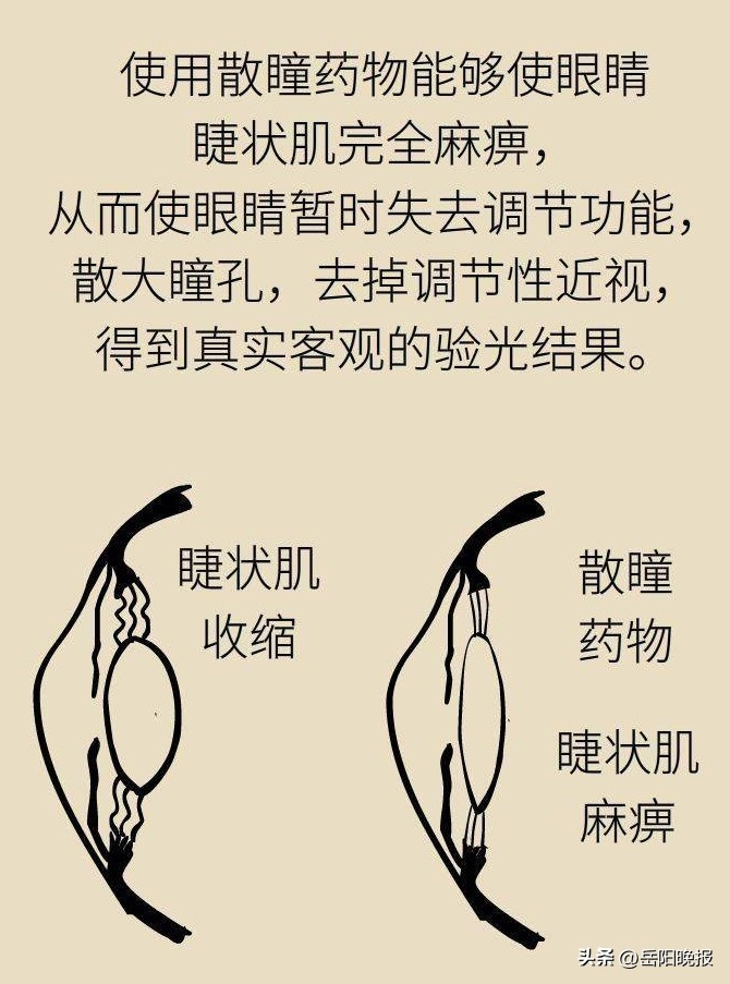 验光散瞳是什么意思,有必要做散瞳验光吗