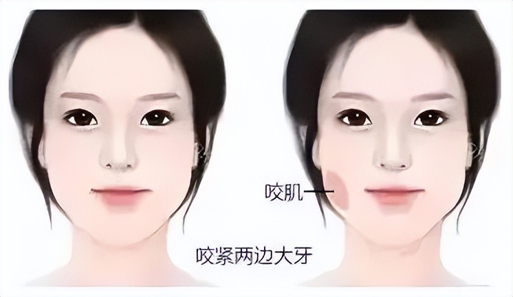 笑的时候脸颊有两坨肉怎么改善,笑起来脸上鼓出两坨肉僵硬