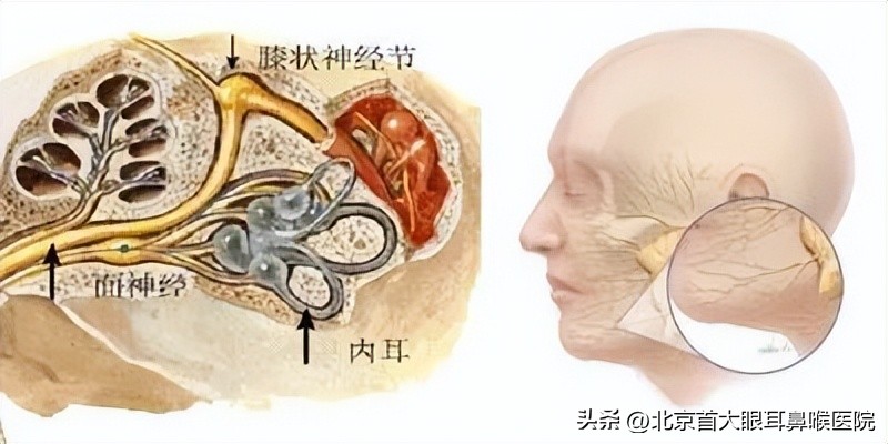 青岛面瘫后遗症谁能治好,面瘫后遗症耳鸣能治好吗
