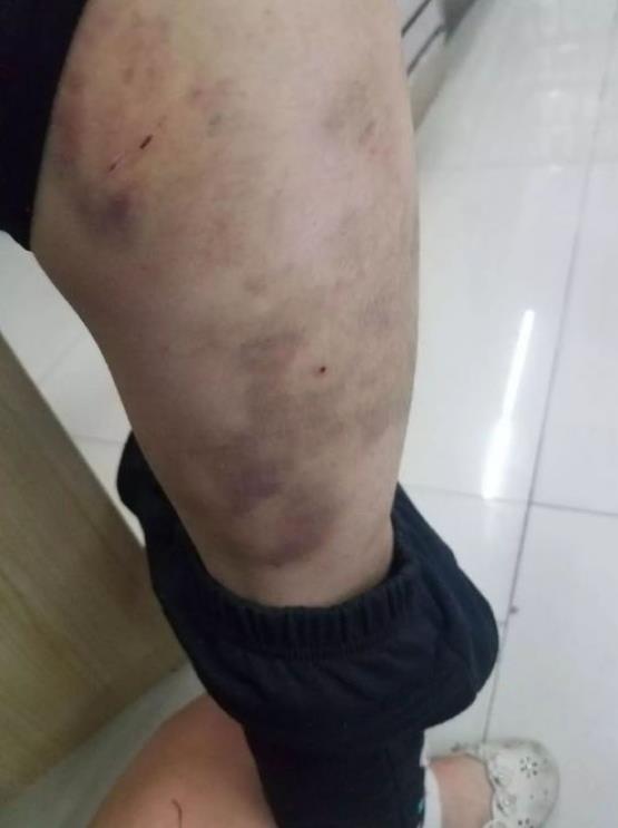 清肾丸治疗紫癜,紫癜针灸治疗