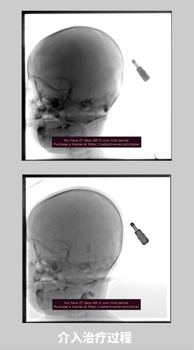 女孩脸上长肿瘤后续,22岁女孩脸上长肿瘤治疗视频