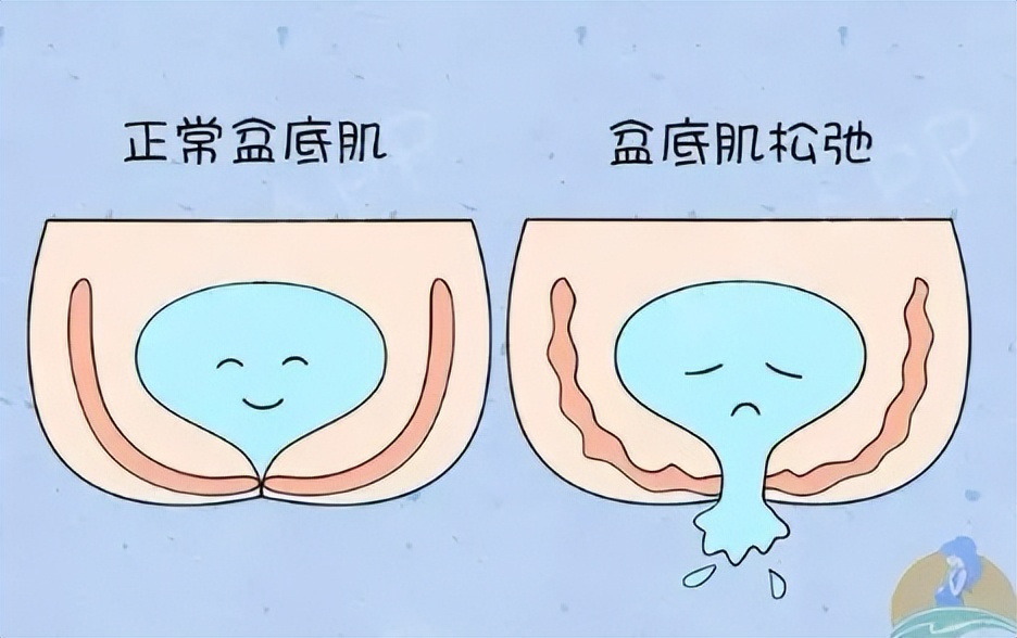 产后漏尿多长时间可以锻炼修复,产后漏尿的调理手法