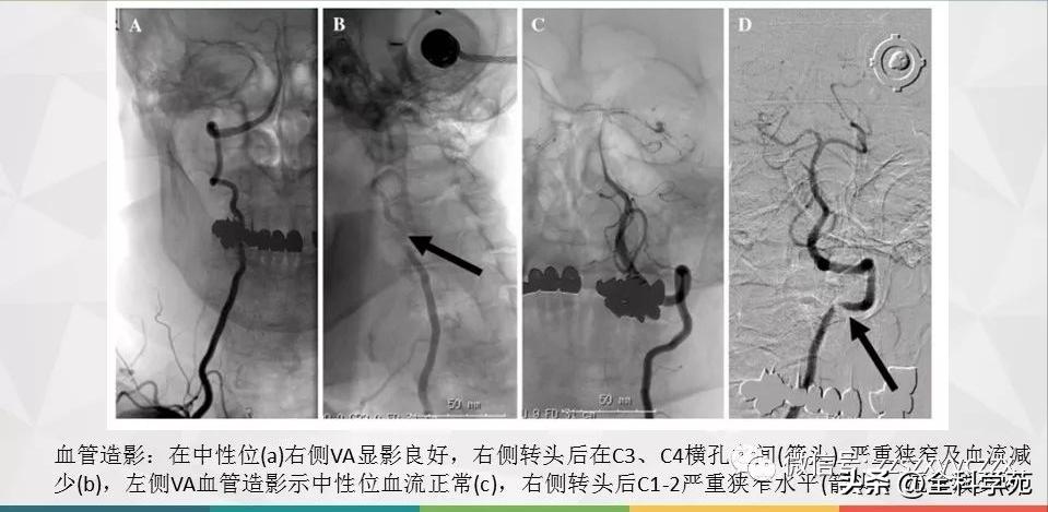 条件反射性眩晕,一种莫名的眩晕