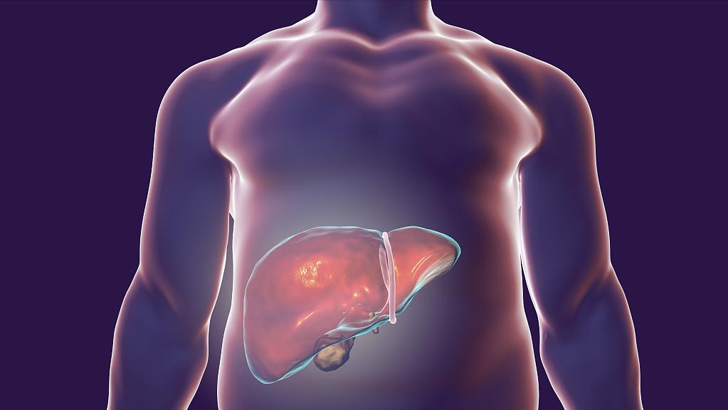 体检总胆红素偏高是肝病吗,肝病患者胆红素升高说明什么