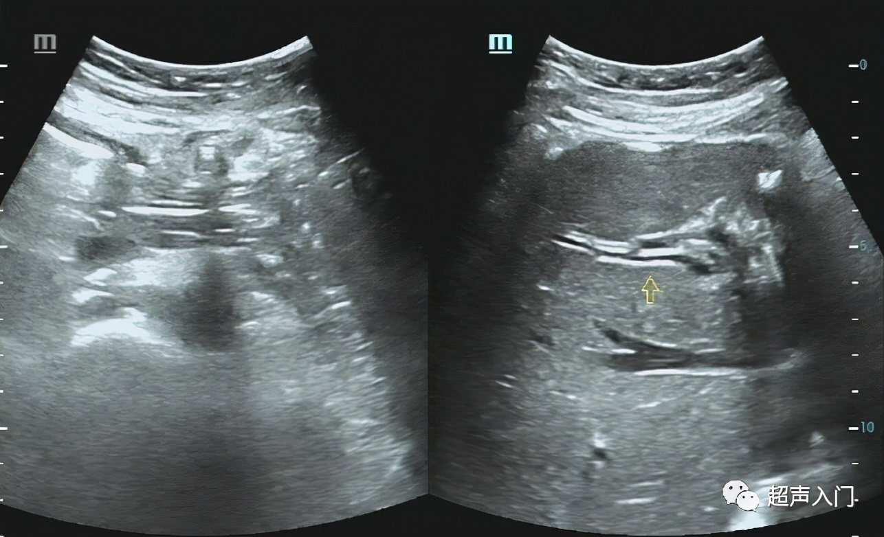 超声学自己能学吗,超声初学者有何窍门