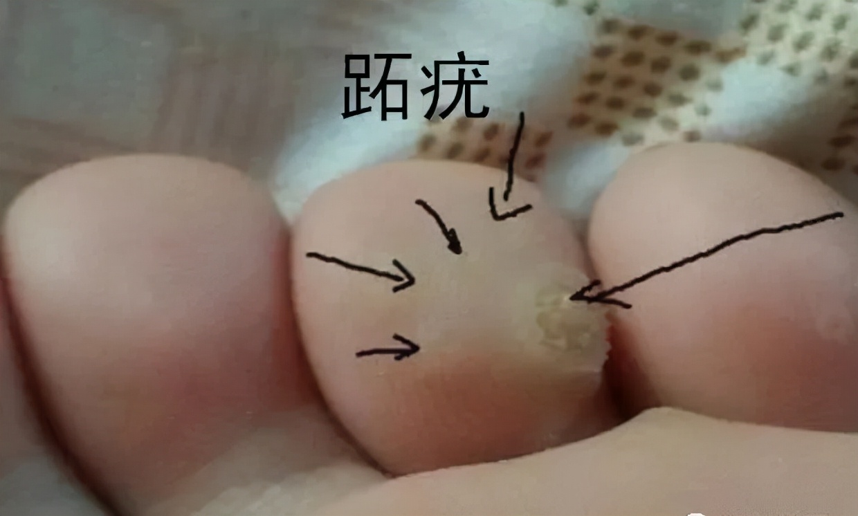 前脚掌长鸡眼有什么治疗方法,脚趾头长鸡眼如何快速治疗