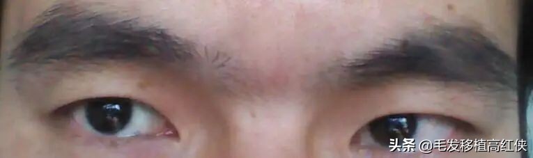 男人眉毛稀疏就要植眉,眉毛稀疏怎么植眉