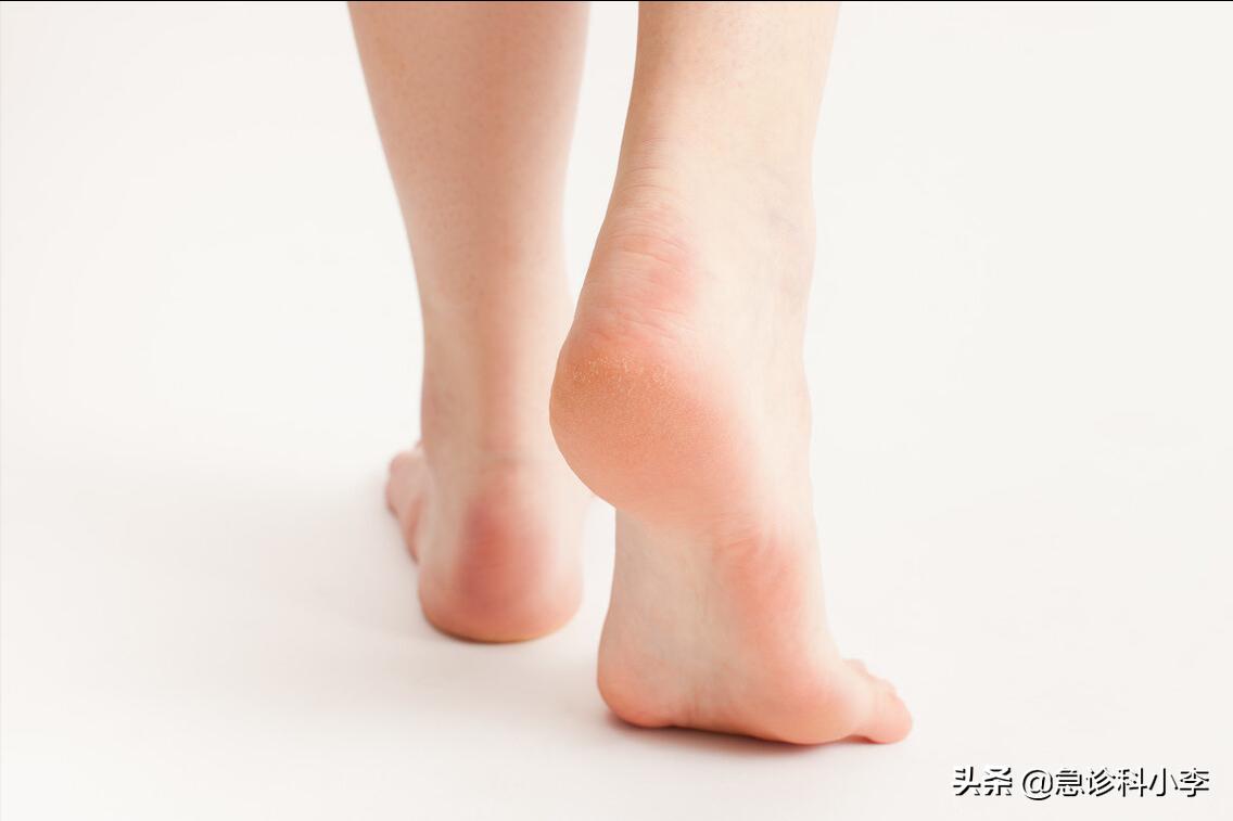 脚气反反复复怎么才能治好,脚气总是反反复复怎么治