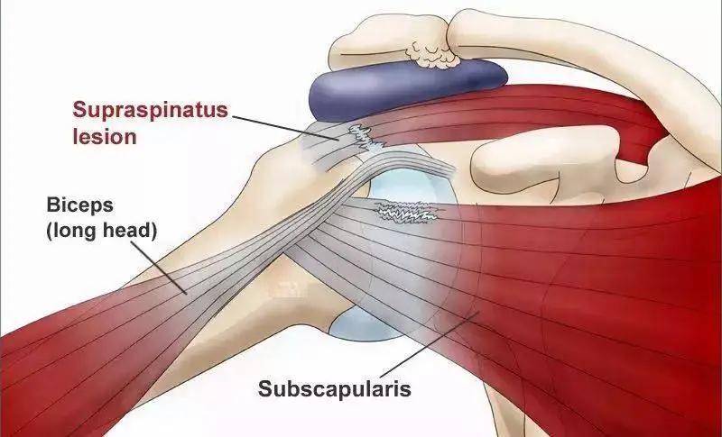 肩膀疼运动一下,运动肩膀疼痛怎么治疗最快最好