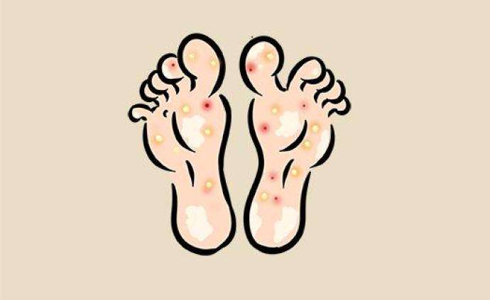 脚气痛痒难耐一个小妙招轻松解决,脚气痒得很怎么解决