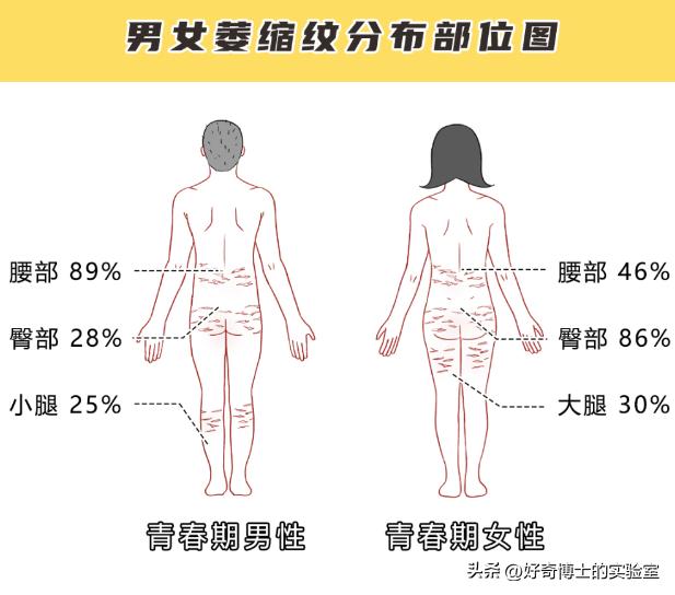 大腿上有白色条纹怎么回事,女生大腿外侧有红条纹是什么原因