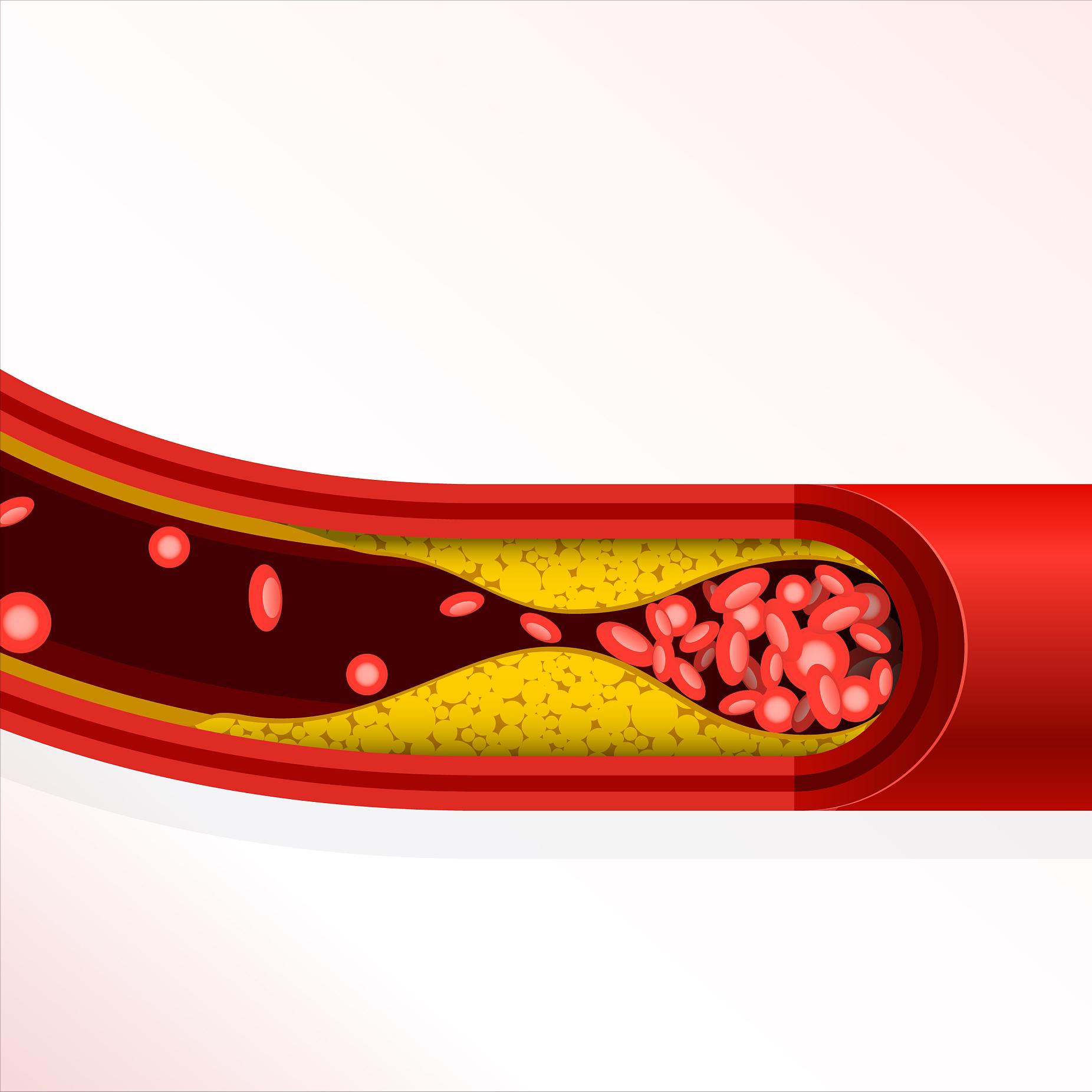 中医治疗血管斑块绝招,中医治疗血管斑块最好的方子