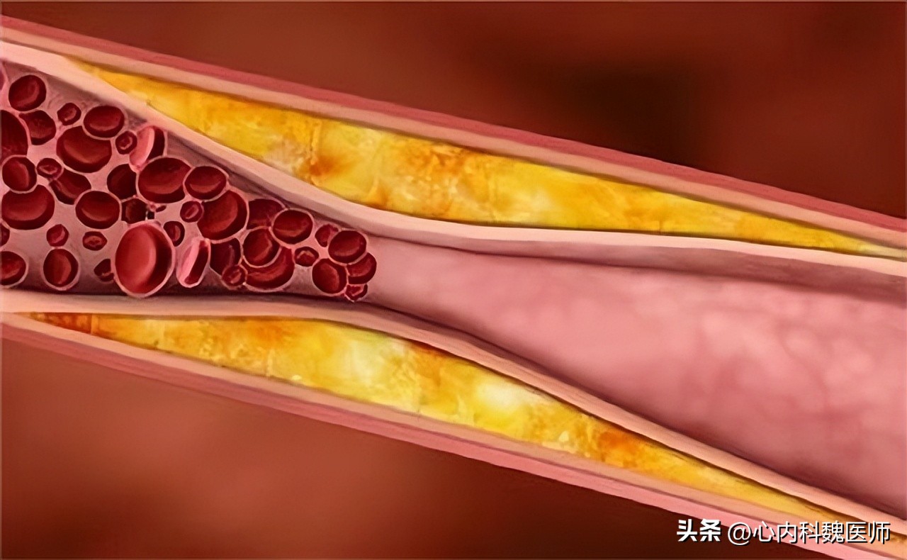 血清脂蛋白a和低密度脂蛋白偏高,脂蛋白a升高吃哪几种药能降得快