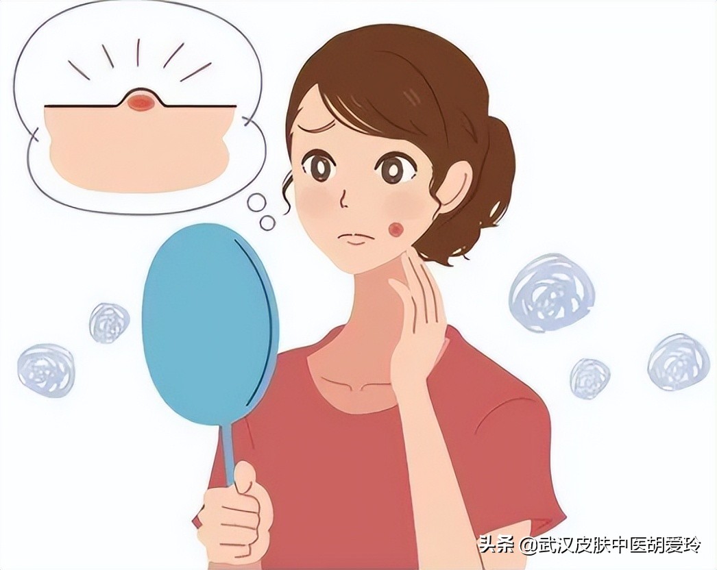 头上长有脓的痘痘怎么回事,脓包型痘痘里的脓怎么处理