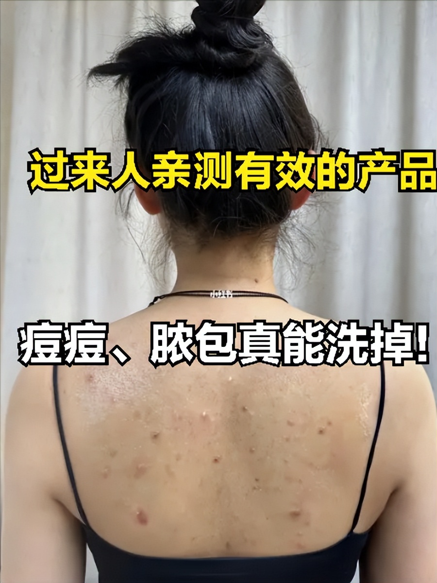 冒脓痘痘,痘痘痘印脓包怎么去除