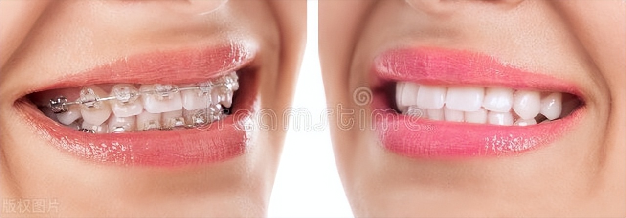 嘴突兔牙矫正哪种牙套适合,骨性嘴凸戴牙套整个过程