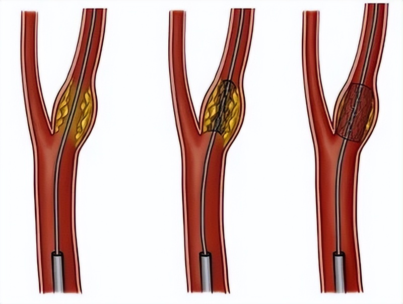 颈动脉斑块如何治疗效果好,颈动脉斑块如何治疗三分钟说清楚