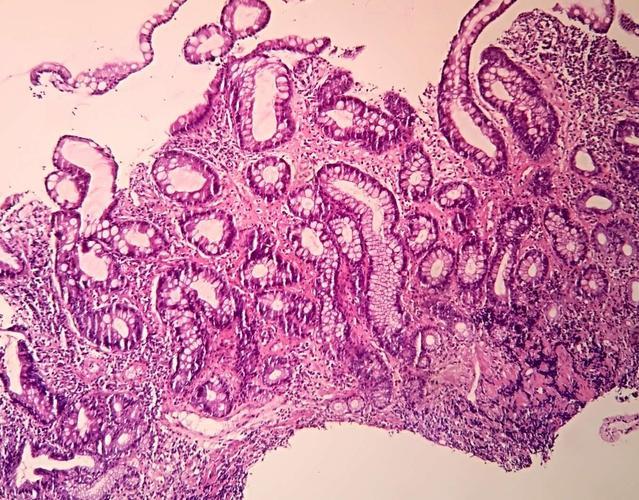 病理报告上肠息肉改变是什么意思,病理报告肠化生是不是萎缩性胃炎