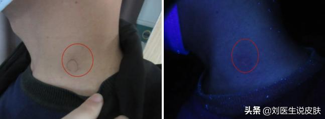 中年男人脖子上长了一个疣,中年男人脖子上出红斑