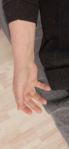 古派针灸,黄贵生针灸视频全集