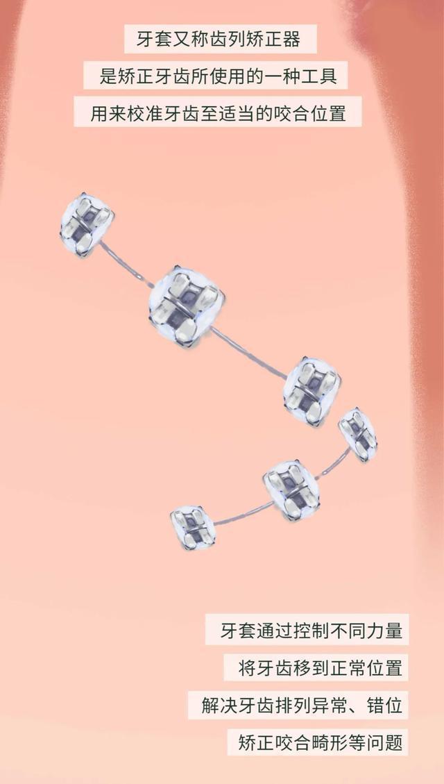 牙套矫正过程漫画,戴牙套是什么体验