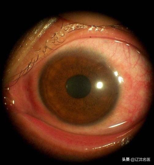 春季过敏性鼻炎结膜炎怎么治疗,过敏性结膜炎的高发季节注意事项