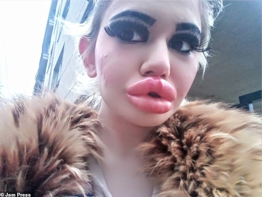 女子狂打30支玻尿酸,丰唇针建议打吗