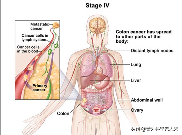 直肠癌腹膜转移一般生存期,结直肠癌腹膜转移治愈的案例