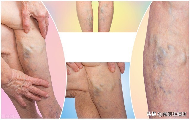 小腿色素沉着溃烂最佳解决方法,小腿静脉皮肤色素沉着溃烂怎么办
