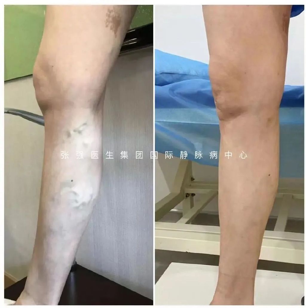 静脉曲张可以根治吗,静脉曲张能治好吗