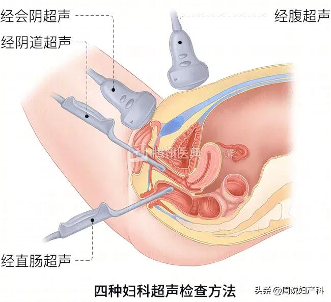如何解读妇科检查报告单,怎么看懂女性妇科检查报告