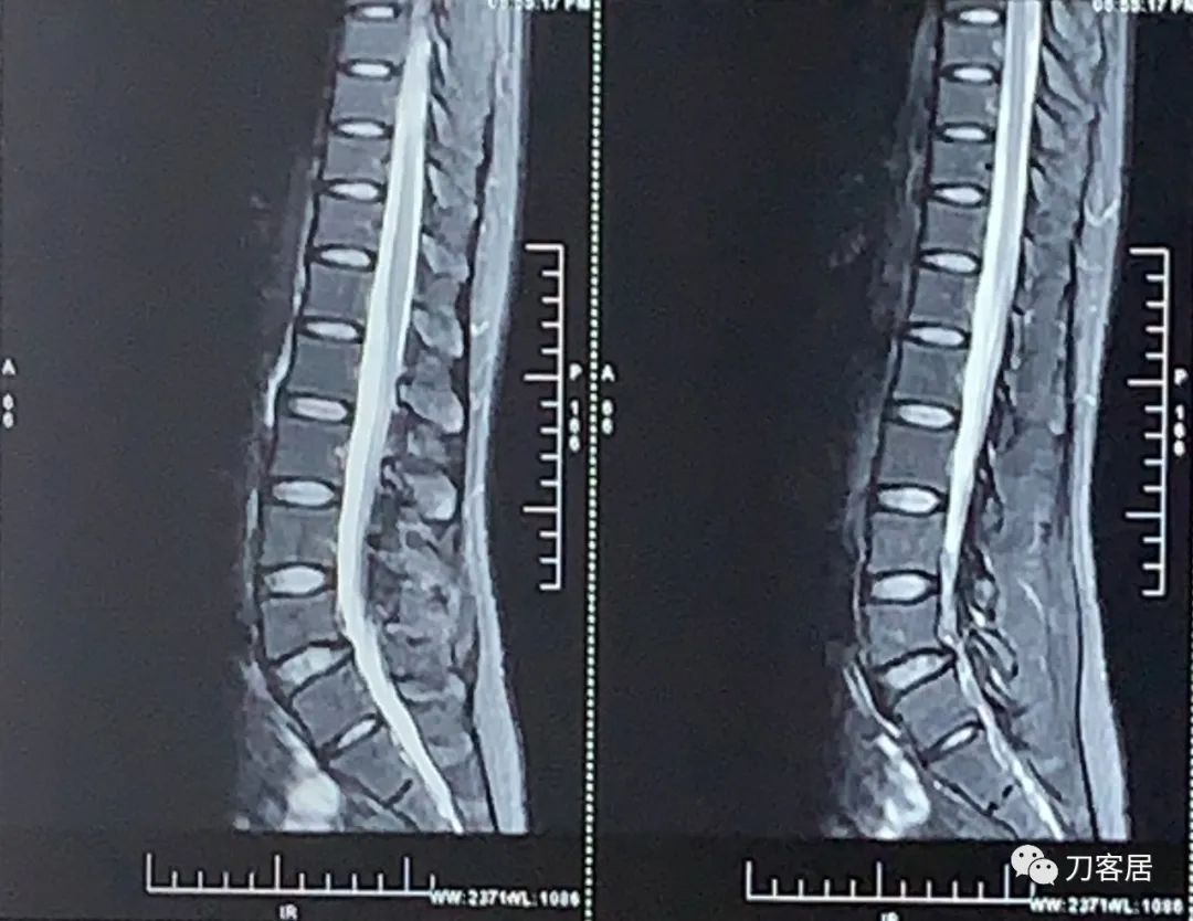 左腰峡部裂能引起右腰疼痛吗,峡部裂会腰痛吗