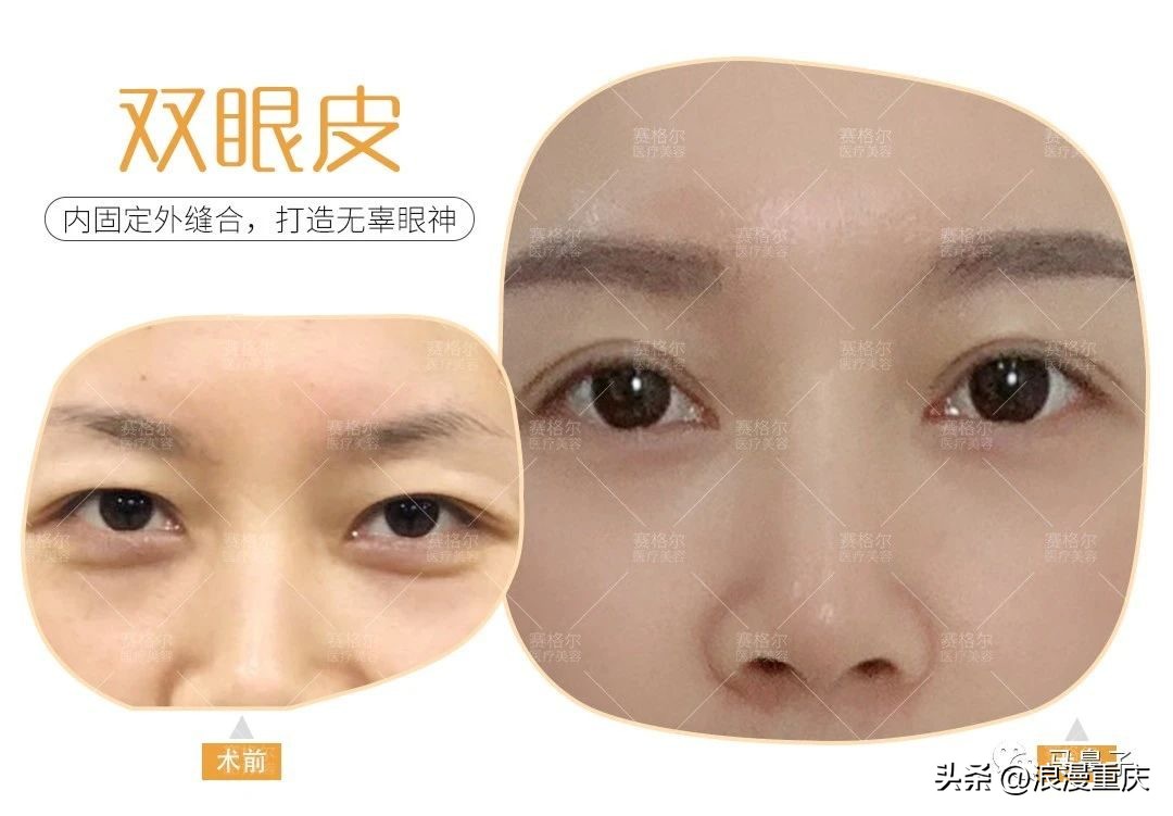 男生单眼皮和双眼皮哪个好,为什么双眼皮比内双好看