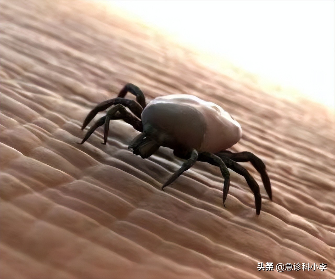 夺命蜱虫咬了是什么样子,夺命蜱虫一家三口被咬两人丧命