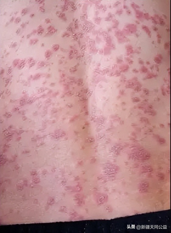 不要错把艾滋病当皮肤病，身体若有3变化，或是艾滋病的信号