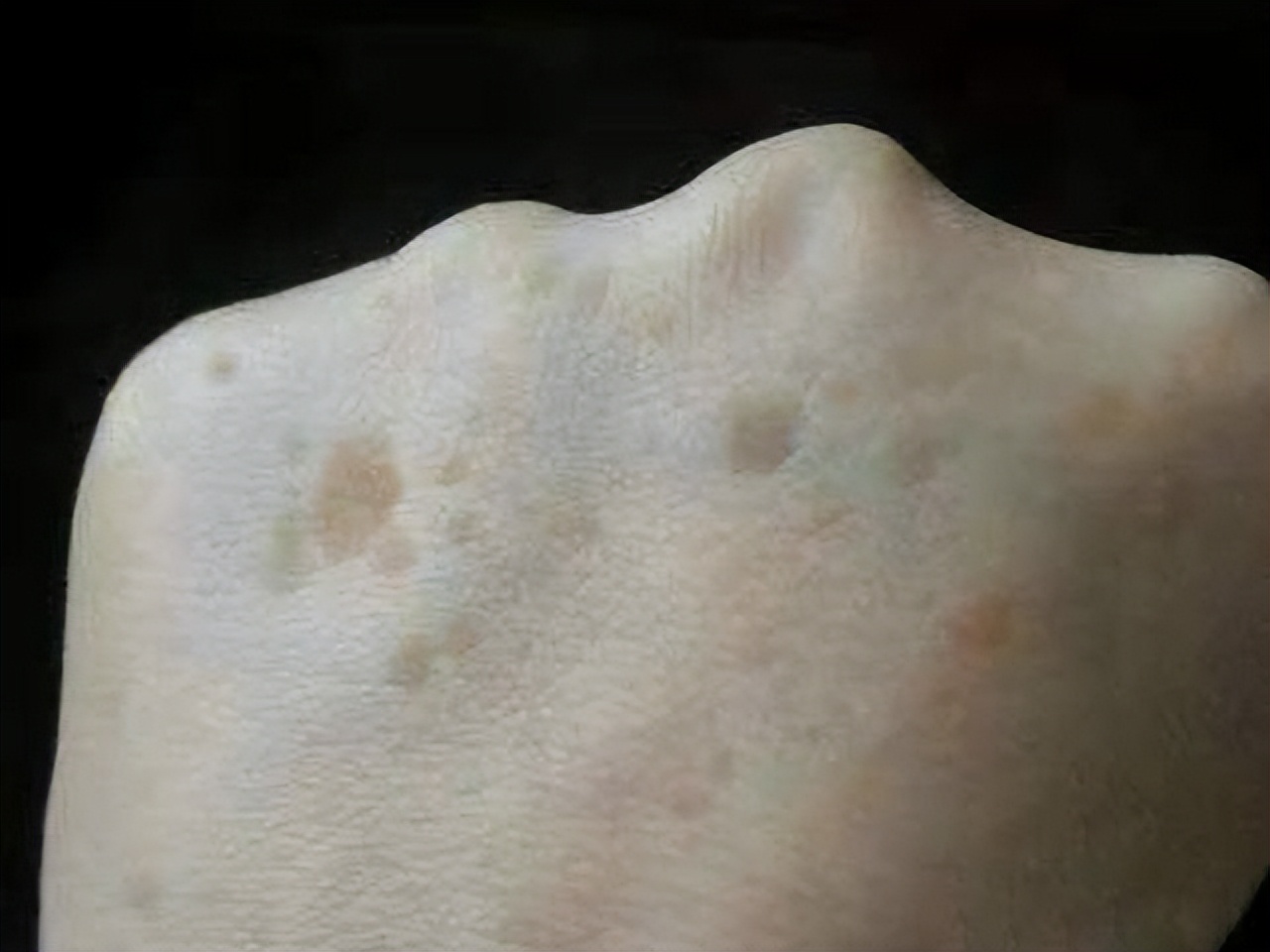 红霉素软膏祛老年斑小妙招,红霉素软膏原来是老年斑克星