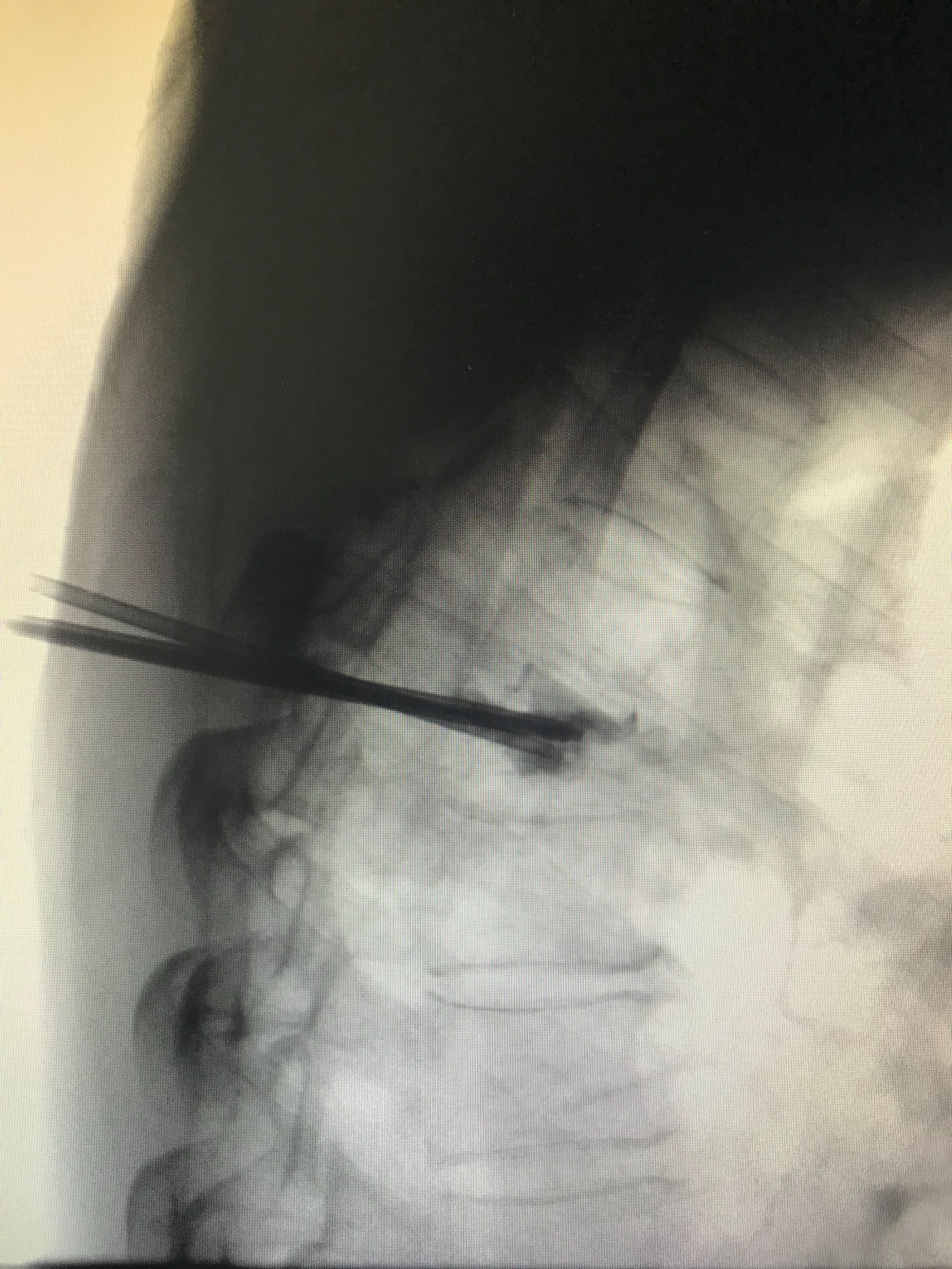 胸椎压缩性骨折微创手术利弊,胸椎压缩性骨折保守治疗20例
