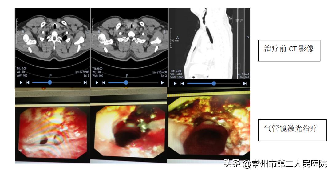 支气管炎引起的气喘可以治愈吗,不明原因的气喘做支气管镜检查