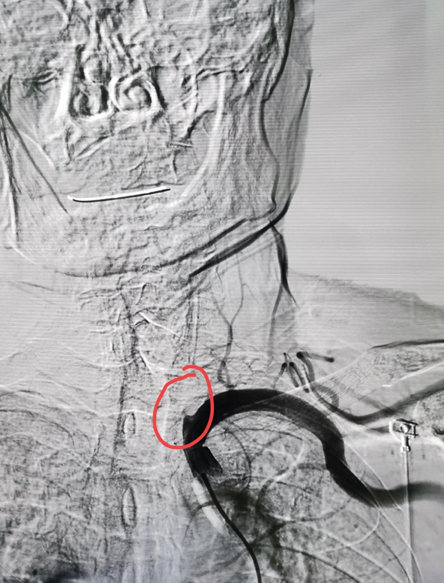 一例头晕，眼睛看东西模糊患者的会诊