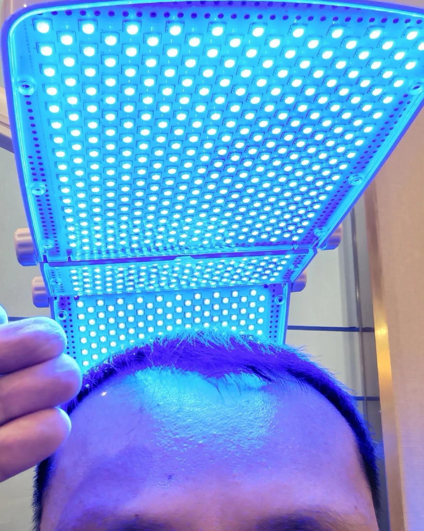 男士植发过来人真实感受,16000字讲述植发真实感受