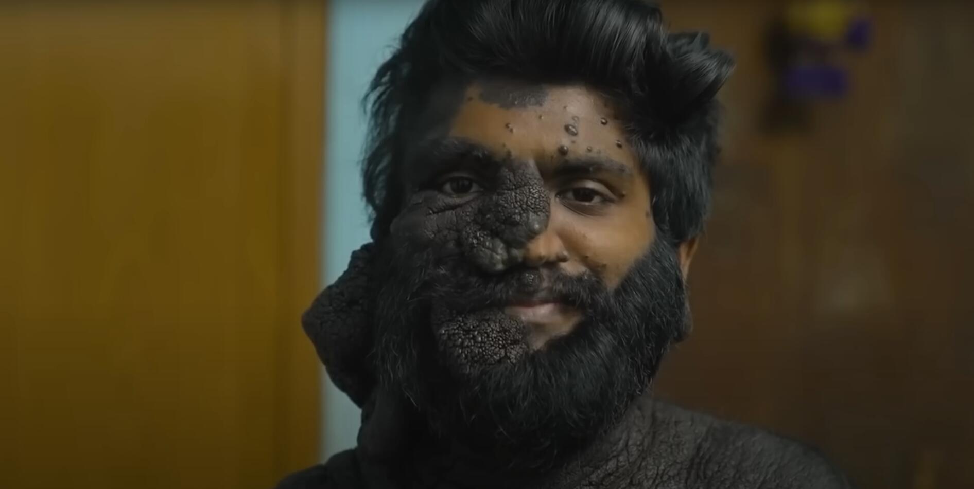 10个难以置信的人类，树皮人、外星人、拥有粗壮手臂的大力水手