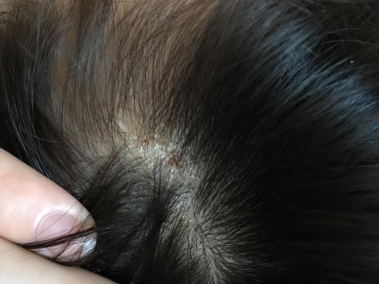 头皮里长的脓包疙瘩是什么原因,头皮上总是长疙瘩和脓包如何根治