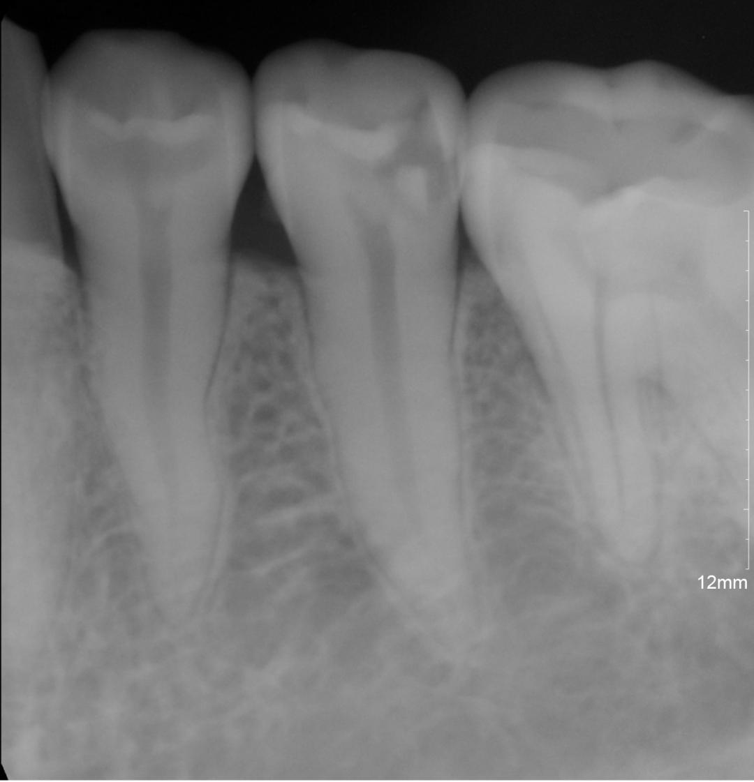 口腔牙龈内壁长硬包是上火吗,牙龈肿痛上火有个脓包怎么办