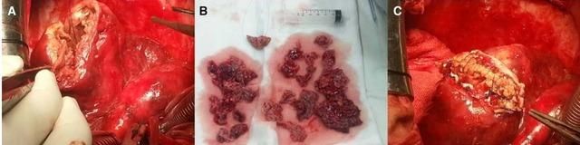 癌症引起腿血栓,孕妇如何预防血栓的发生