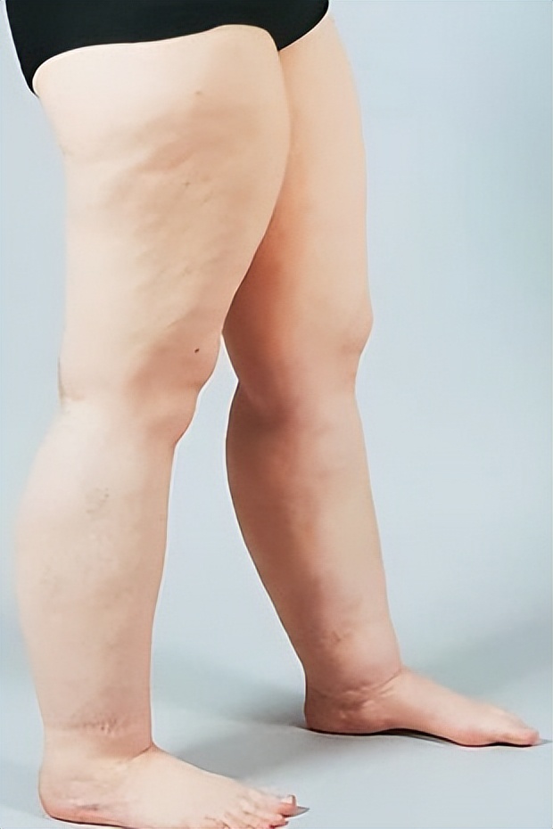 女子因癌症截肢,女子重病瘫痪20年最后被发现